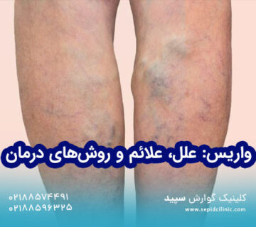 واریس: علل، علائم و روشهای درمان