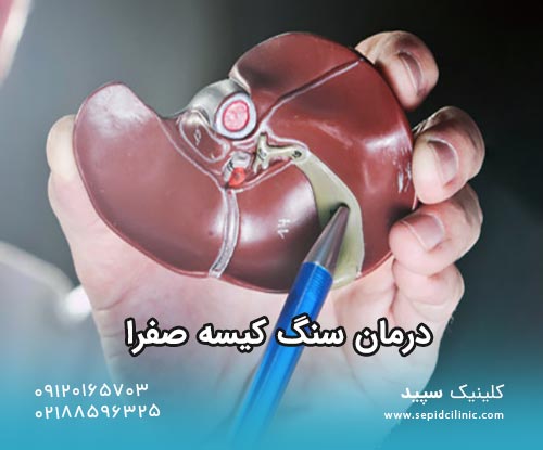 تشخیص و درمان سنگ کیسه صفرا