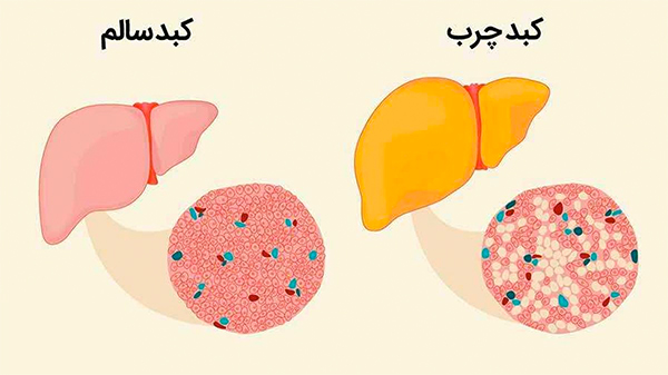 تفاوت کبد چرب و کبد سالم