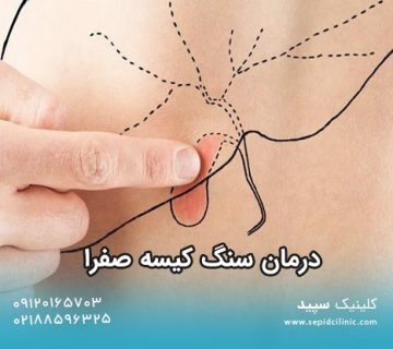 درمان کیسه صفرا در کلینیک گوارش سپید