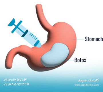 مقایسه تزریق بوتاکس معده با سایر روش های لاغری