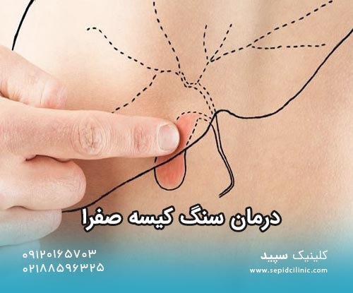 درمان کیسه صفرا در کلینیک گوارش سپید