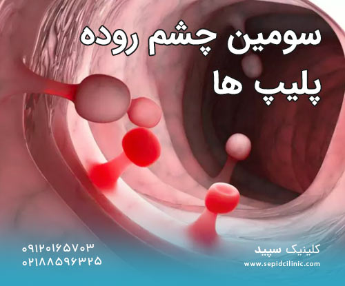 سومین چشم روده پلیپ ها