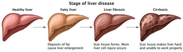 فیبرو اسکن برای تشخیص بیماری کبدی