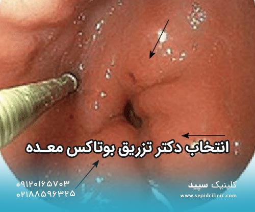 انتخاب دکتر تزریق بوتاکس معده