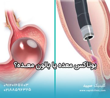 بوتاکس معده یا بالون معده؟