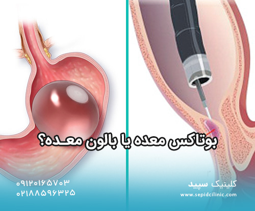 بوتاکس معده یا بالون معده؟