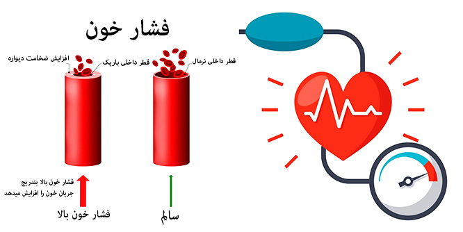 درمان و کنترل فشار خون