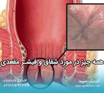 همه چیز در مورد شقاق و فیشر مقعدی