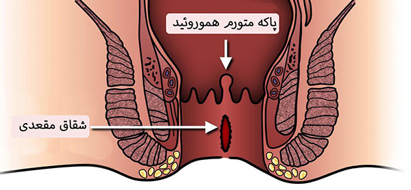 تفاوت هموروييد و شقاق