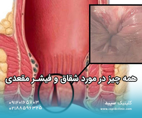 همه چیز در مورد شقاق و فیشر مقعدی