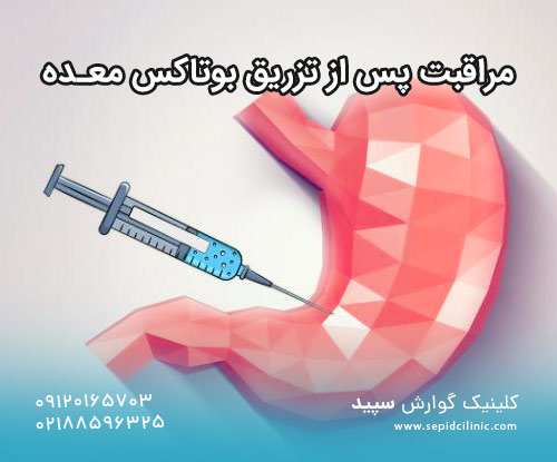 مراقبت پس از تزریق بوتاکس معده