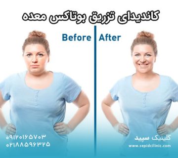 کاندیدای تزریق بوتاکس معده