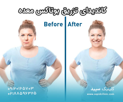 کاندیدای تزریق بوتاکس معده