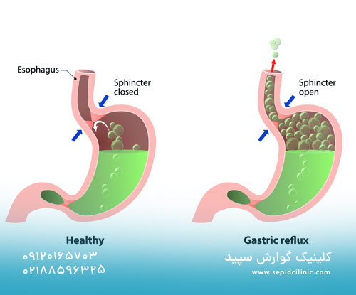 رفلاکس معده