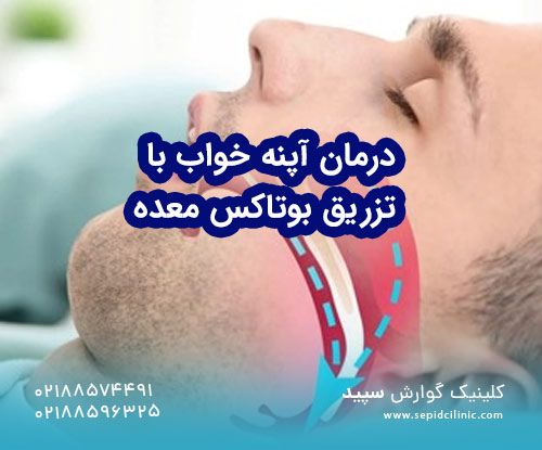 درمان آپنه خواب با تزریق بوتاکس معده