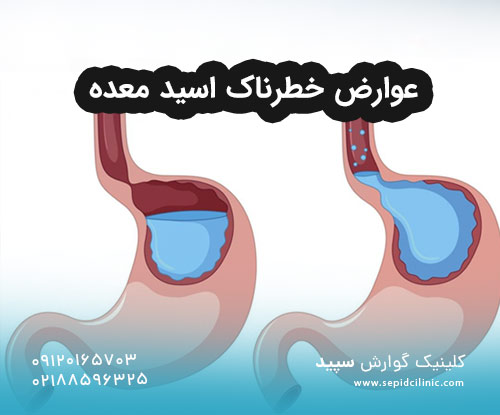 عوارض خطرناک اسید معده