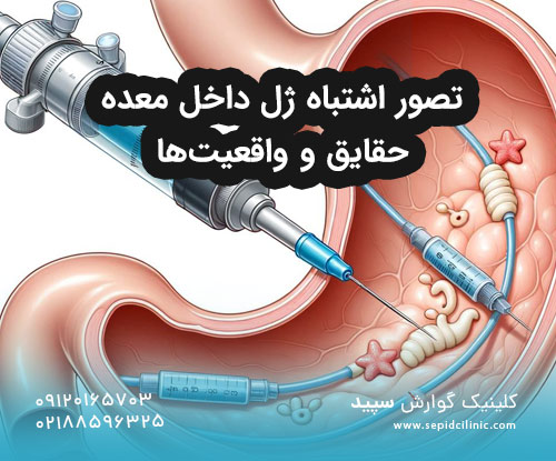 تصور اشتباه ژل داخل معده