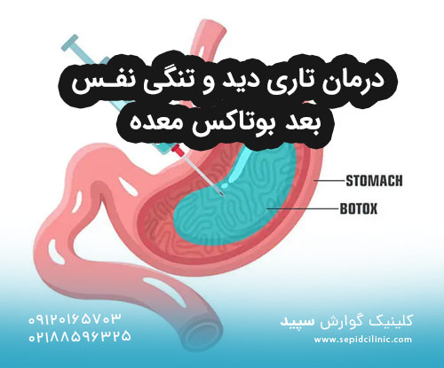 درمان تاری دید و تنگی نفس بعد بوتاکس معده