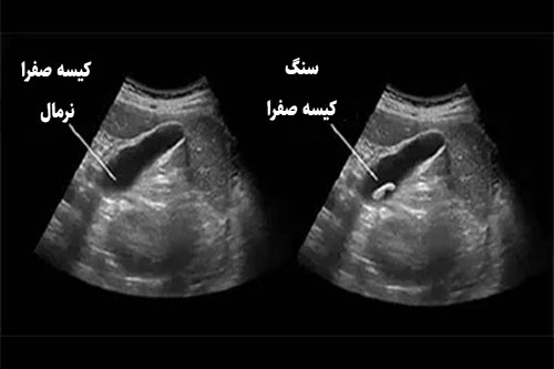 تفسیر نتیجه سونوگرافی کیسه صفرا