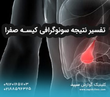 تفسیر نتیجه سونوگرافی کیسه صفرا