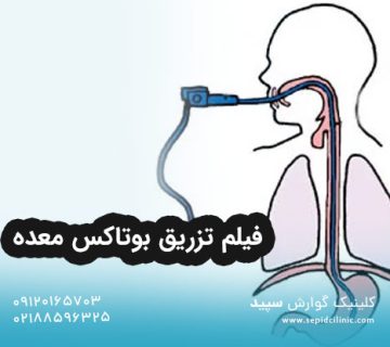 فیلم تزریق بوتاکس معده