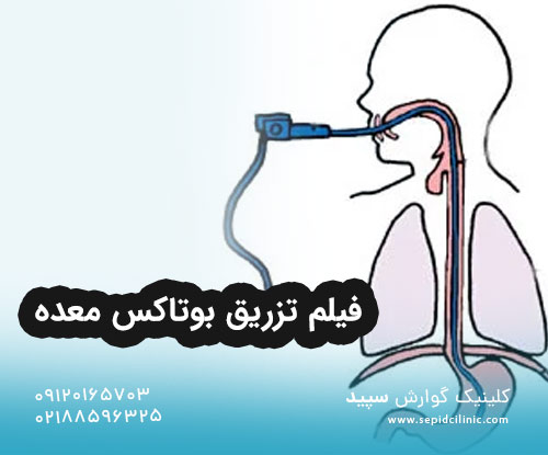 فیلم تزریق بوتاکس معده