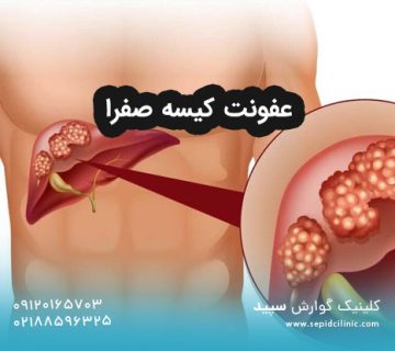 عفونت کیسه صفرا
