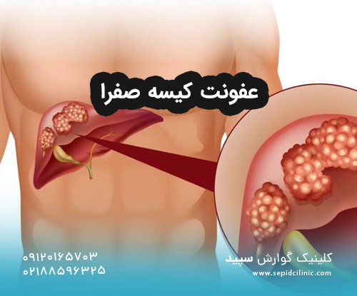 عفونت کیسه صفرا