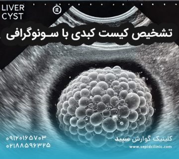 تشخیص کیست کبدی با سونوگرافی
