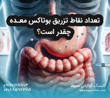 تعداد نقاط تزریق بوتاکس معده