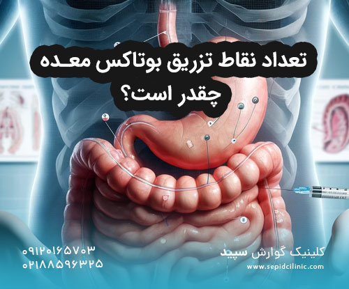 تعداد نقاط تزریق بوتاکس معده