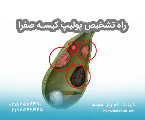 راه تشخیص پولیپ کیسه صفرا