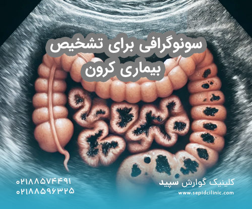 سونوگرافی برای تشخیص بیماری کرون