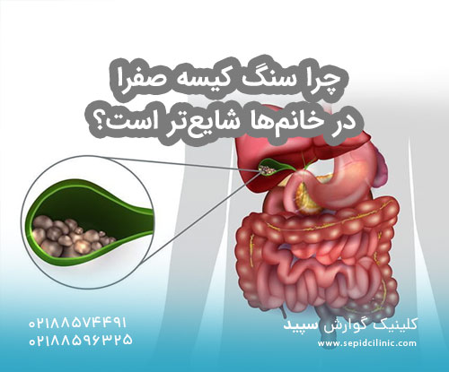 چرا سنگ کیسه صفرا در خانم‌ها شایع‌تر است؟