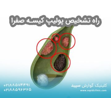 راه تشخیص پولیپ کیسه صفرا