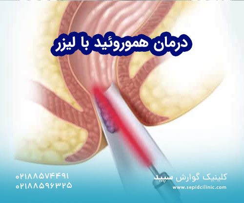 درمان هموروئید با لیزر
