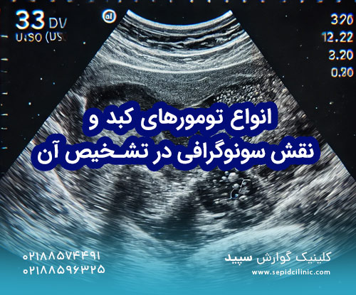 انواع تومورهای کبد و نقش سونوگرافی در تشخیص آن‌ها