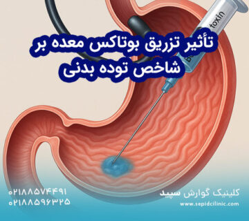 تأثیر تزریق بوتاکس معده بر شاخص توده بدنی