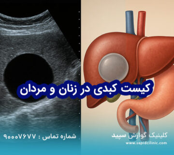 کیست کبدی در زنان و مردان