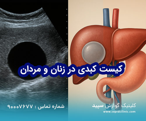 کیست کبدی در زنان و مردان
