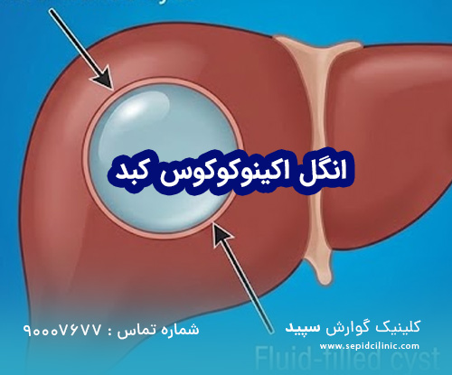 انگل اکینوکوکوس