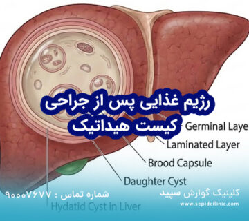 راهنمای جامع مراقبت‌ها و رژیم غذایی پس از جراحی کیست هیداتیک