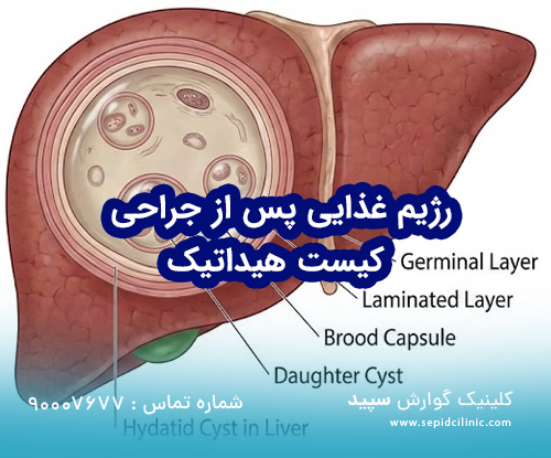 راهنمای جامع مراقبت‌ها و رژیم غذایی پس از جراحی کیست هیداتیک
