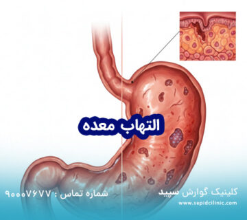 تشخیص و درمان التهاب معده