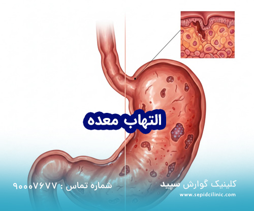تشخیص و درمان التهاب معده