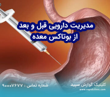 مدیریت دارویی قبل و بعد از بوتاکس معده