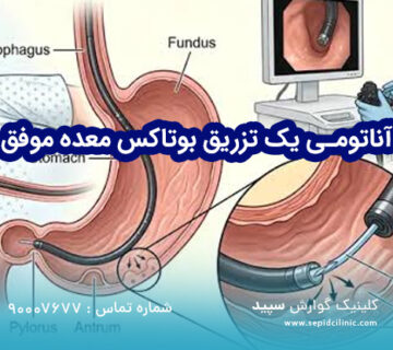 آناتومی یک تزریق بوتاکس معده موفق