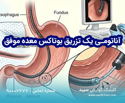 آناتومی یک تزریق بوتاکس معده موفق