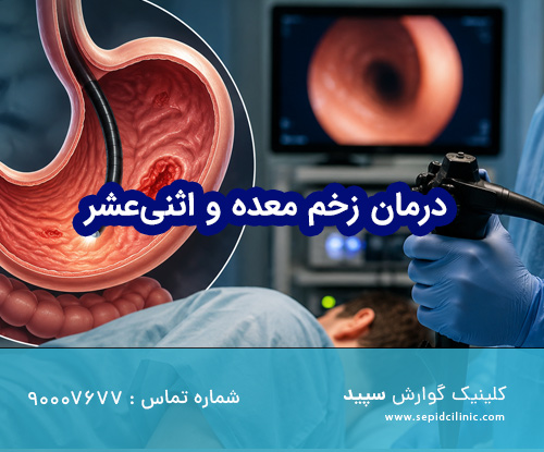 درمان زخم معده و اثنی‌عشر با آندوسکوپی
